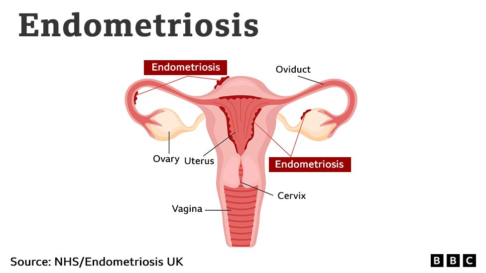 A graphic showing endometriosis