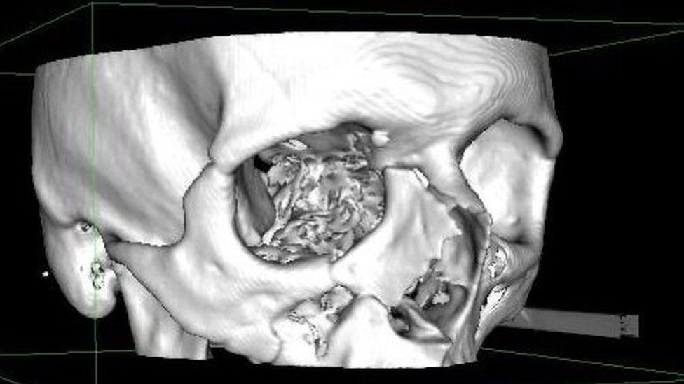 Scan of skull showing injuries