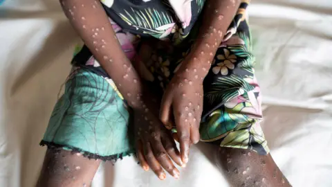 Reuters Young girl with monkeypox lesions on her arms and legs