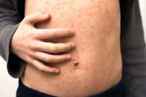 Getty Images A person's stomach which has a measles rash all over it. They are holding their stomach with their right hand.