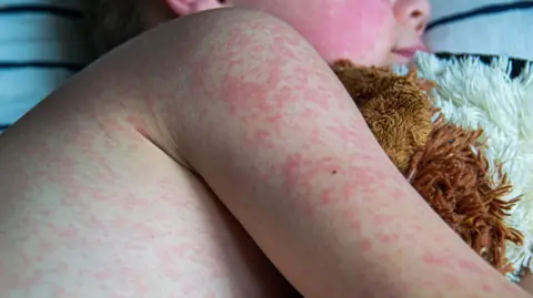 Getty Images side profile of a child hugging a cuddly animal. The child looks like he is sleeping, and he has blotchy red patches across his arm and body. There are so many of them on his face that they have joined together into one big red patch