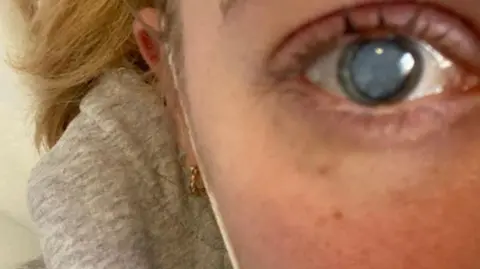 Ellie Irwin A close-up of Ellie's right eye which shows a cataract - a cloudy light blue circle in the centre of the eye - which causes blurry vision