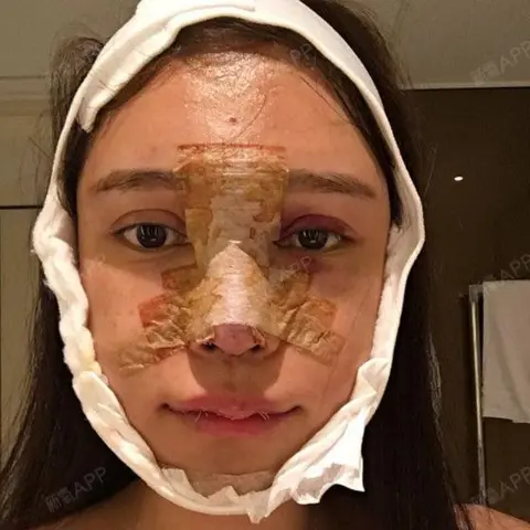 Abby Wu A young woman with a thick brown plaster stretching across almost the entirety of her nose and much of her face. A white bandage is wrapped around the edge of her face, including her chin, and there are signs of bruising and blood on parts of her face. 