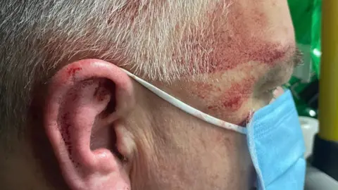 WMAS A side view of a man's face which is cut. He has grey hair and is wearing a blue medical face mask. His ear is also cut with dried blood on it. 