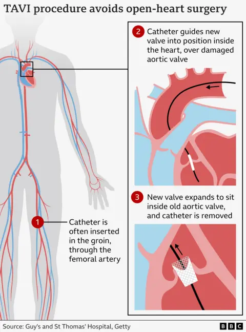 Graphic illustrating how the TAVI procedure works by inserting  a new valve via a catheter through a blood vessel.