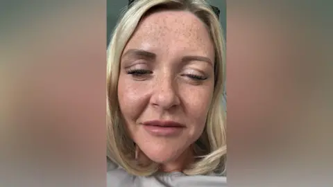 Nicola Fairley Nicola Fairley, a blonde woman in her 30s. One side of her face swollen and the eye closed, which are symptoms of botulism.