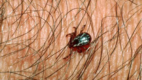 Getty Images A tick crawling through body hair on a persons skin