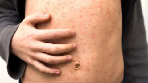 Getty Images A child's torso covered in the red spots of a measles rash