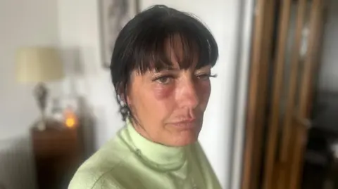 Paula Harrison, a woman in her 50s with black hair and wearing a lime green top. She has a large red rash beneath each eye and her left eye lid is drooping.