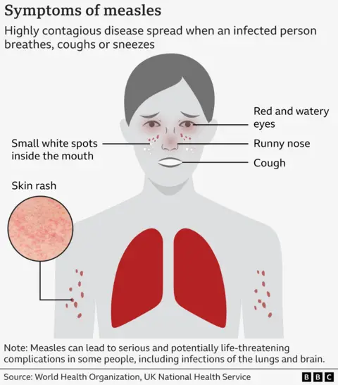 Graphic showing how measles symptoms present on a body, including red and watery eyes, runny nose, a cough, a skin rash and small white spots inside the mouth. The lungs are also highlighted, reflecting the risk of possible pulmonary infection. 