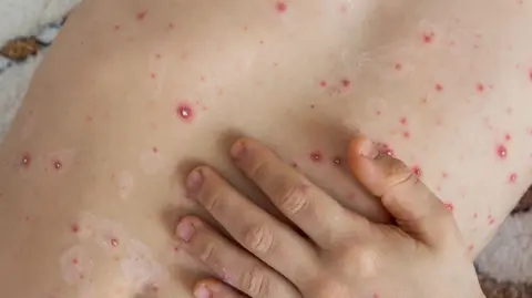 Getty Images A child, lying on a rug, reveals their tummy rash that is red with some scabs