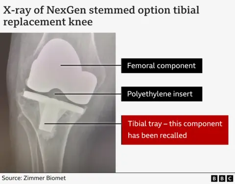 Graphic: X-Ray of NexGen stemmed option tibial replacement knee. Labels: Femoral component, Polyethylene insert, Tibial tray - this component has been recalled