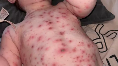 Sarah Mia's chickenpox rash was red, painful, itchy and blistering