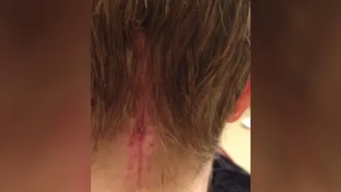 Charlotte Chapman-Hart A photograph of the back of Charlotte's head showing a brain surgery scar which is 22 stitches long