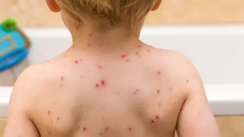 Getty Images An image of a young child's back with red spots. 