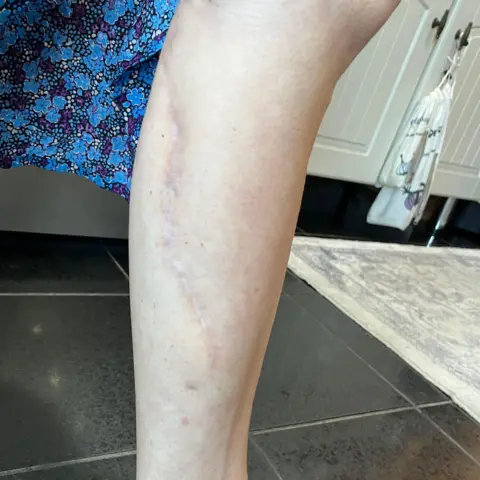 A woman is showing her leg, which has a long scar down the back of her calf following an operation to reconstruct her tongue with veins and artery from her leg.