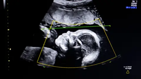 Getty Images An image of a baby's head shown on screen on an ultrasound scan. It is a grainy black-and-white image of the side of the head. You can clearly see the nose and eyes. Overlaid on the top of the image are data from the imaging machine including a yellow box and a green dotted line.